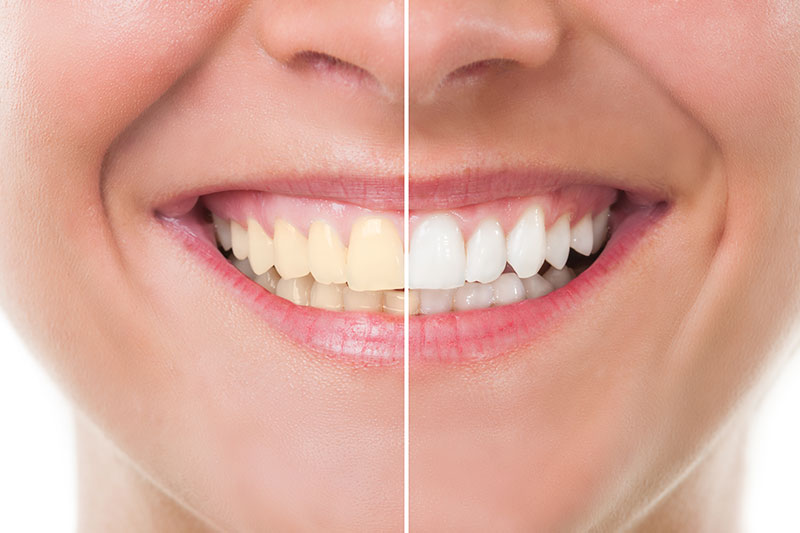 Teeth Whitening in Litchfield Park